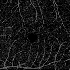 OCTA Image of Retina